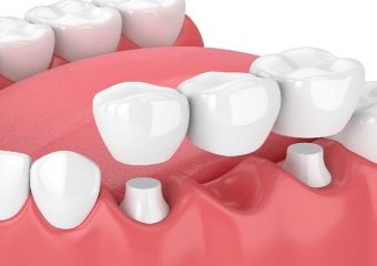 بریج دندان چیست؟ | بهترین دندانپزشک اصفهان