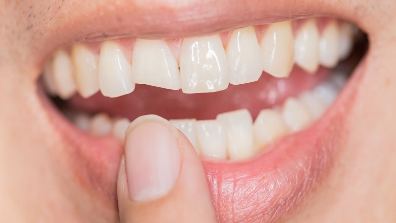 روش های ترمیم دندان شکسته | بهترین دندانپزشک اصفهان