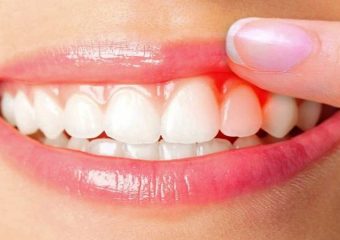 روش های پیشگیری و درمان عفونت دندان | بهترین دندانپزشک اصفهان