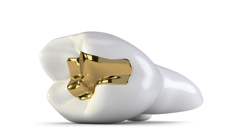 مراحل قرارگیری اینله و انله دندان | بهترین ایمپلنت اصفهان