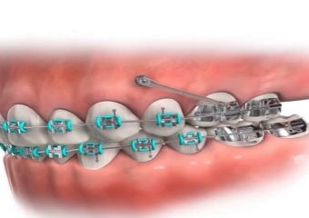 معایب و مزایای مینی اسکرو | بهترین دندانپزشک اصفهان