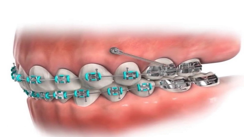 معایب و مزایای مینی اسکرو | بهترین دندانپزشک اصفهان