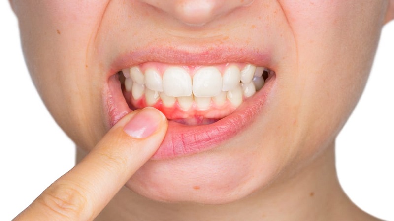 پیوند لثه چیست | بهترین دندانپزشک اصفهان
