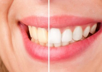 9 علت مهم و تاثیرگذار برای زردی دندان ها | بهترین ایمپلنت اصفهان