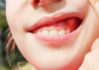 عوارض کیست دندان چیست؟ | بهترین ایمپلنت اصفهان