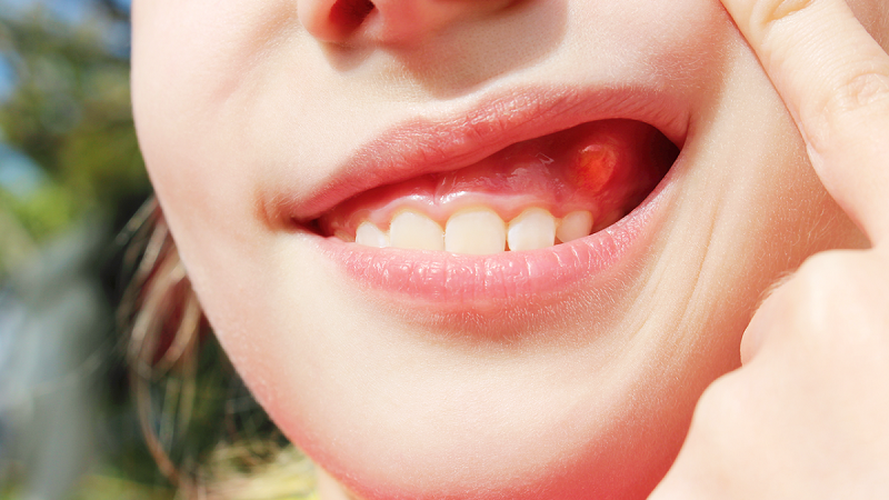 عوارض کیست دندان چیست؟ | بهترین ایمپلنت اصفهان