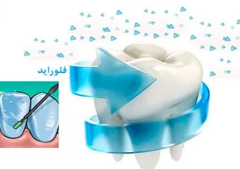 فلوراید برای کودکان | بهترین دندانپزشک اصفهان