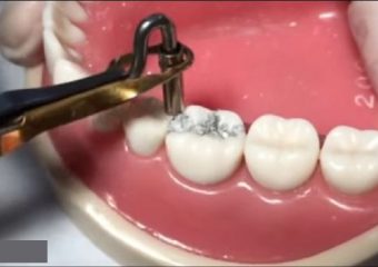 پر یا ترمیم کردن همرنگ دندان | بهترین ایمپلنت اصفهان