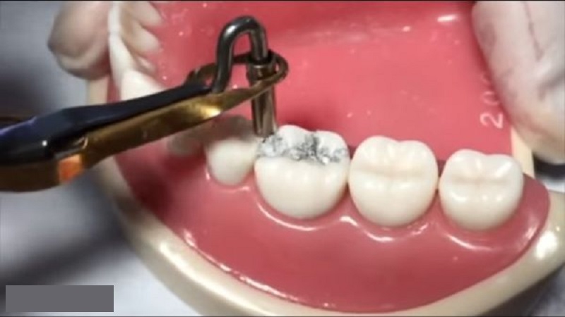 پر یا ترمیم کردن همرنگ دندان | بهترین ایمپلنت اصفهان
