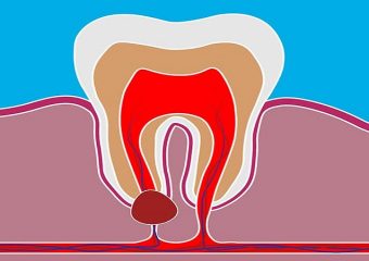 کیست دندان چگونه ایجاد می شود؟ | بهترین ایمپلنت اصفهان