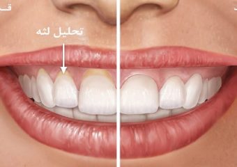 درمان تحلیل لثه چگونه است؟ | بهترین دندانپزشک اصفهان