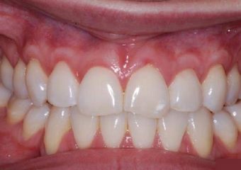 علت تحلیل رفتن لثه چست؟ | بهترین دندانپزشک اصفهان