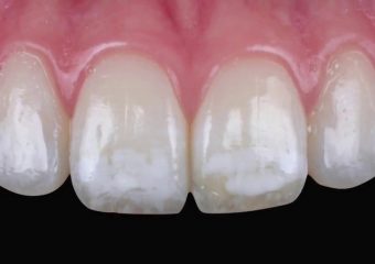 فلوروزیس دندانی در کودکان | بهترین ایمپلنت اصفهان