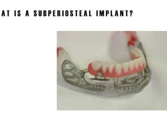ایمپلنت ساب پریوستیال | بهترین ایمپلنت اصفهان