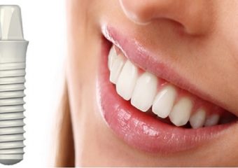 ایمپلنت‌ اندوستیال دندان | بهترین ایمپلنت اصفهان