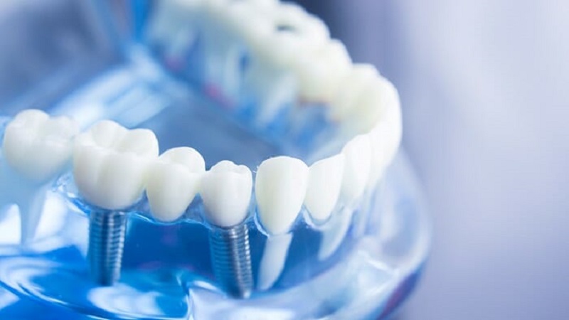 ایمپلنت‌های دندانی زیر پریوستال | بهترین ایمپلنت اصفهان