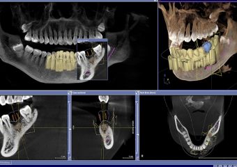 جراحی ایمپلنت دیجیتال چیست؟ | بهترین ایمپلنت اصفهان