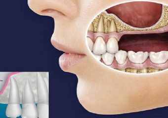 جراحی سینوس لیفت | بهترین ایمپلنت اصفهان