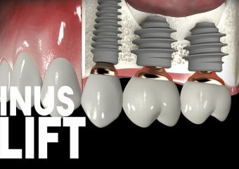 سینوس لیفت چیست؟ | بهترین ایمپلنت اصفهان