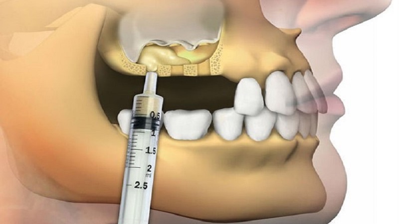 سینوس لیفت چیست؟ | بهترین ایمپلنت اصفهان