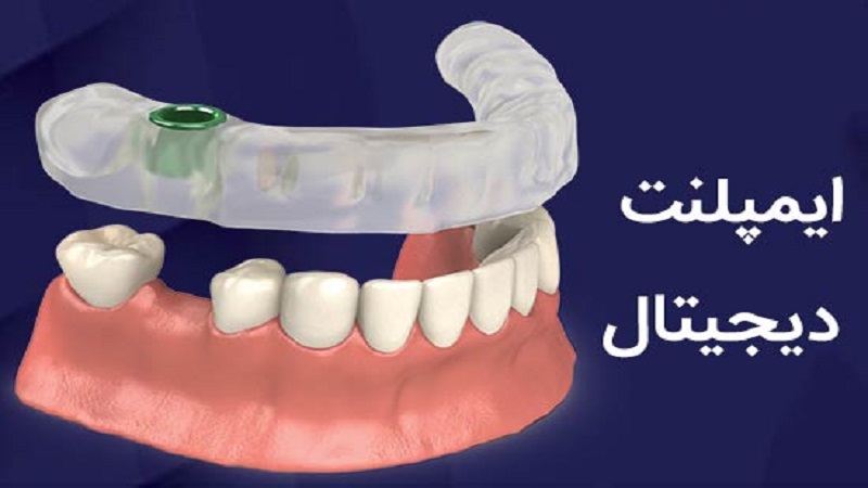 مزایای ایمپلنت های دندانپزشکی دیجیتال | بهترین ایمپلنت اصفهان