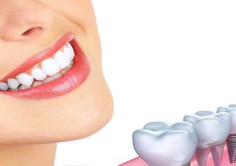 کاشت دندان چیست؟ | بهترین ایمپلنت اصفهان