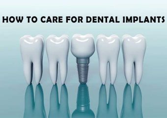 ۷ نکته برای مراقبت از ایمپلنت‌های دندان خود | بهترین دندانپزشک اصفهان