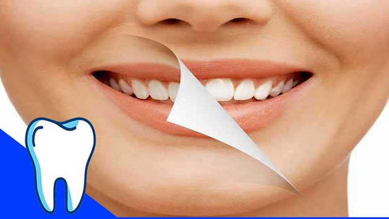 بررسی بلیچینگ دندان و انواع آن | بهترین ایمپلنت اصفهان