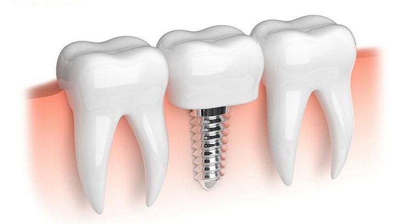 بهداشت و مراقبت از پروتز ایمپلنت | بهترین دندانپزشک اصفهان