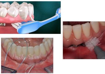 بهداشت و مراقبت از پروتز ایمپلنت | بهترین دندانپزشک اصفهان