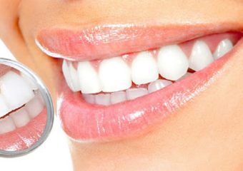 تفاوت بلیچینگ و جرم گیری | بهترین ایمپلنت اصفهان