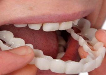 تفاوت کامپوزیت و روکش دندان | بهترین دندانپزشک اصفهان