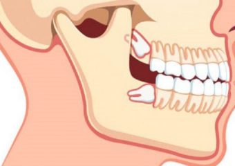 جراحی دندان عقل | بهترین ایمپلنت اصفهان