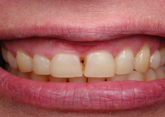 سیاه شدن بین دو دندان | بهترین ایمپلنت اصفهان