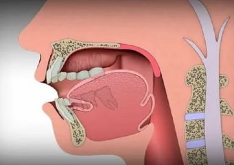 علل خارش سقف دهان | بهترین دندانپزشک اصفهان