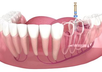 عوامل موثر در آسیب پالپ | بهترین ایمپلنت اصفهان