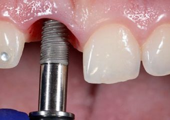 قبل از ایمپلنت دندان های فک بالا بدانید | بهترین دندانپزشک اصفهان