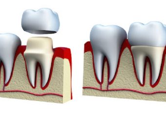 نیاز به روکش پس از عصب کشی دندان | بهترین ایمپلنت اصفهان