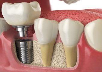 ویژگی ها و مزایا ایمپلنت دندان | بهترین ایمپلنت اصفهان