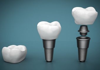 اجزای ایمپلنت | بهترین ایمپلنت اصفهان