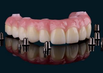 بررسی اجزای ایمپلنت | بهترین ایمپلنت اصفهان