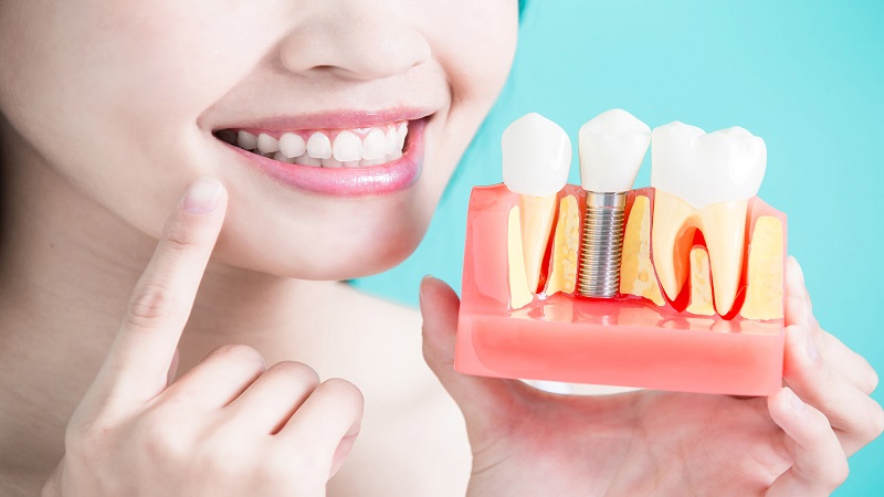 بررسی ایمپلنت های دندانی | بهترین ایمپلنت اصفهان