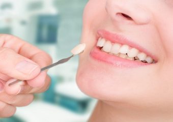 بررسی کاربرد لمینت دندانی | بهترین ایمپلنت اصفهان