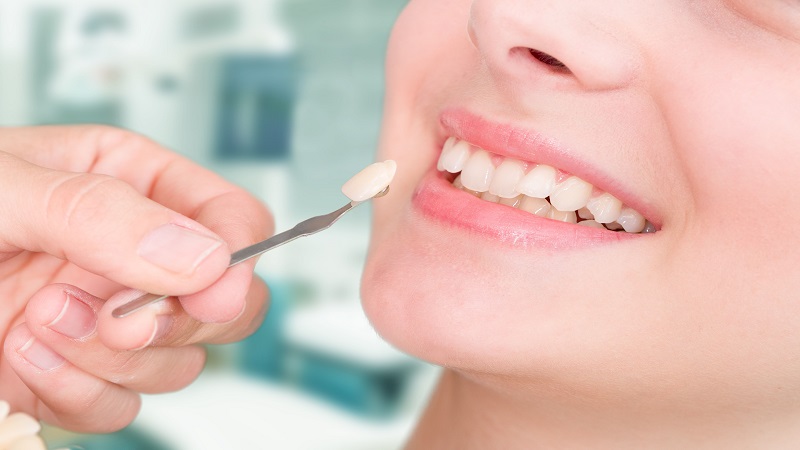 بررسی کاربرد لمینت دندانی | بهترین ایمپلنت اصفهان