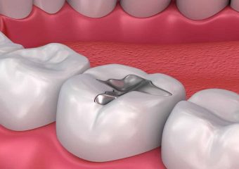 شکستن ترمیم های آمالگام | بهترین ایمپلنت اصفهان