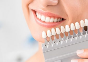 مزایای لمینت دندان | بهترین ایمپلنت اصفهان