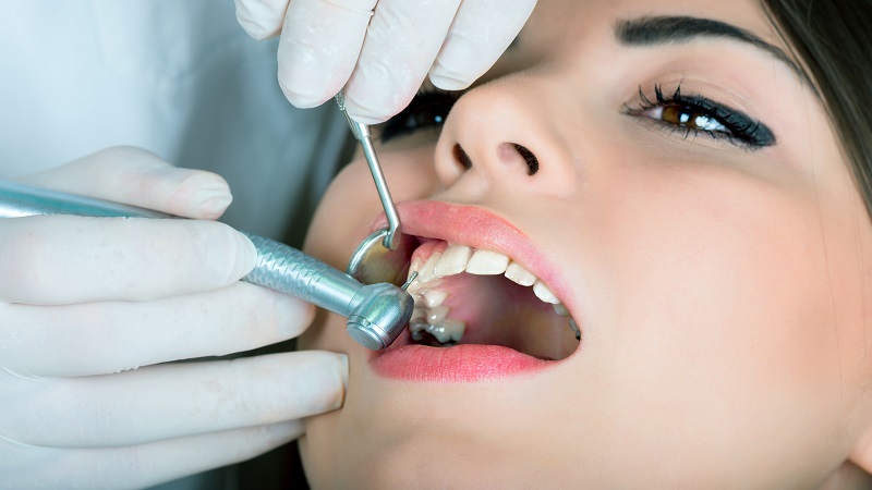 معایب و مزایای مواد پر کننده دندان | بهترین دندانپزشک اصفهان