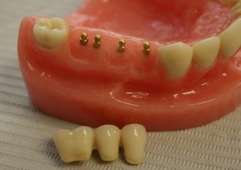 پرسش های پیرامون مینی ایمپلنت | بهترین دندانپزشک اصفهان