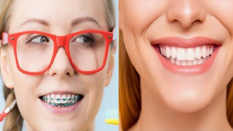 ارتودنسی بهتر است یا لمینت دندان؟ | بهترین دندانپزشک اصفهان
