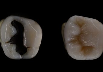تفاوت آمالگام و کامپوزیت | بهترین دندانپزشک زیبایی اصفهان